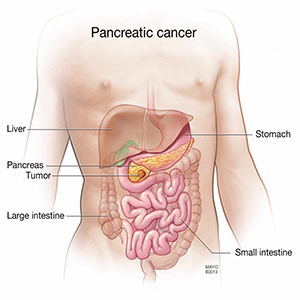kanker-pankreas