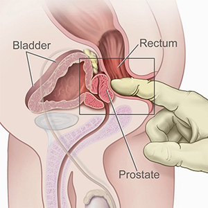 kanker-prostat