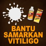 Menyamarkan Vitiligo Dengan Jelly Gamat